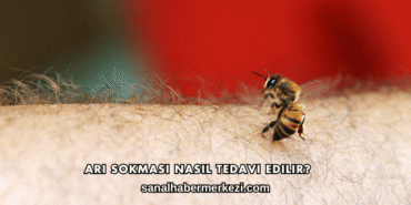 Arı Sokması Nasıl Tedavi Edilir?