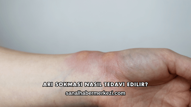 Arı Sokması Nasıl Tedavi Edilir?