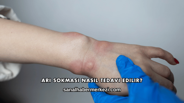 Arı Sokması Nasıl Tedavi Edilir?